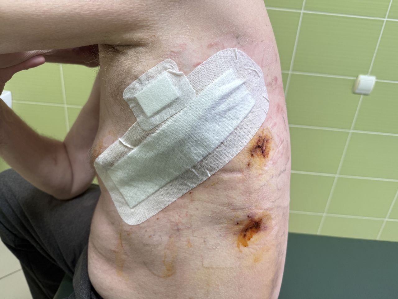 Розривом грудного лімфатичного протоку